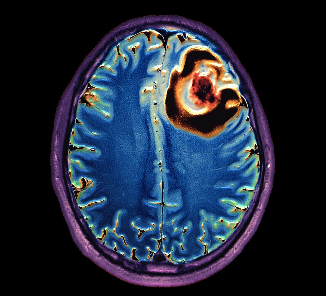 Brain abscess, MRI scan