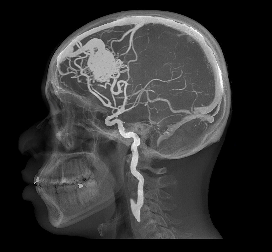 Cerebral arteriovenous malformation, CT scan