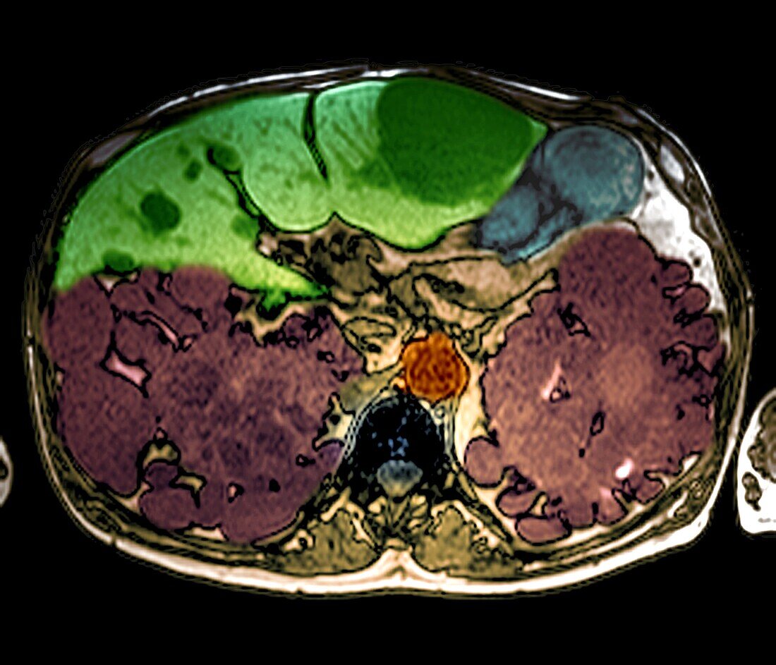 Polycystic kidney disease, MRI scan