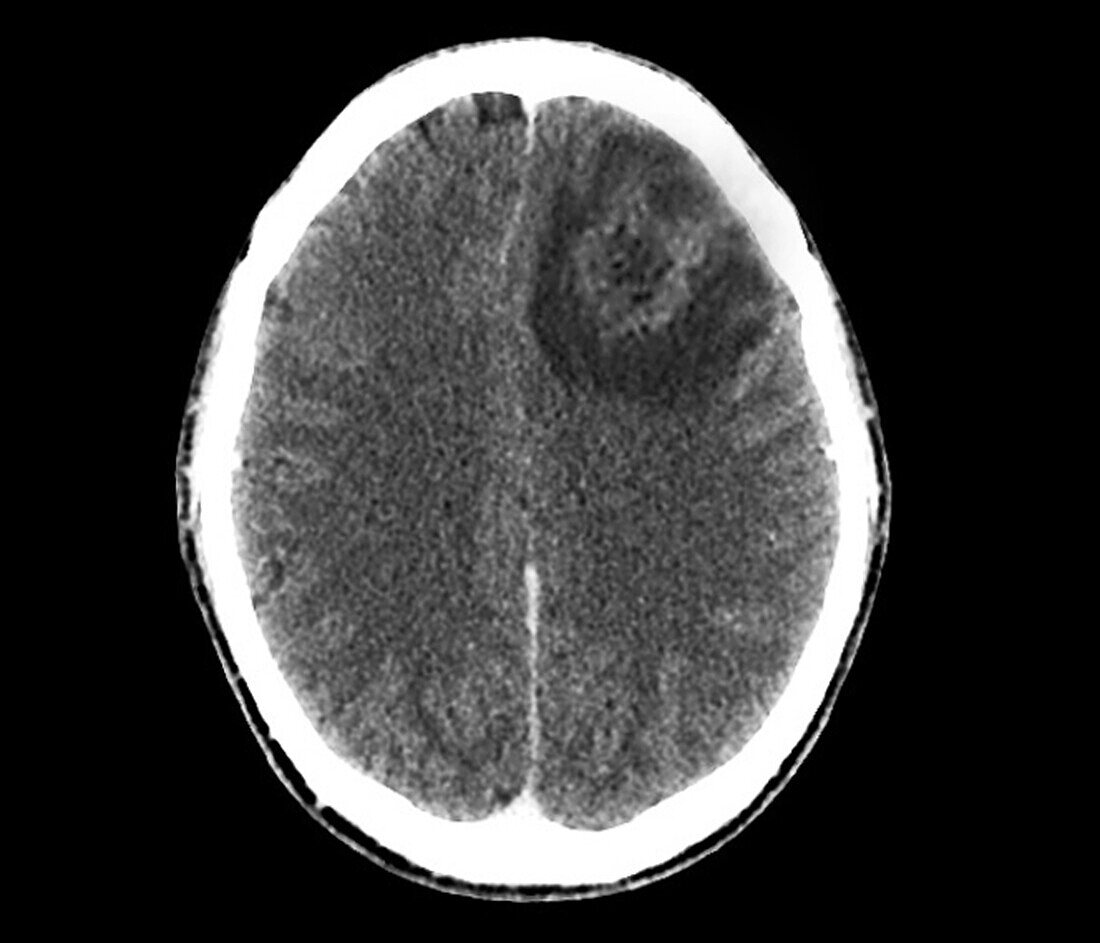 Brain abscess, CT scan