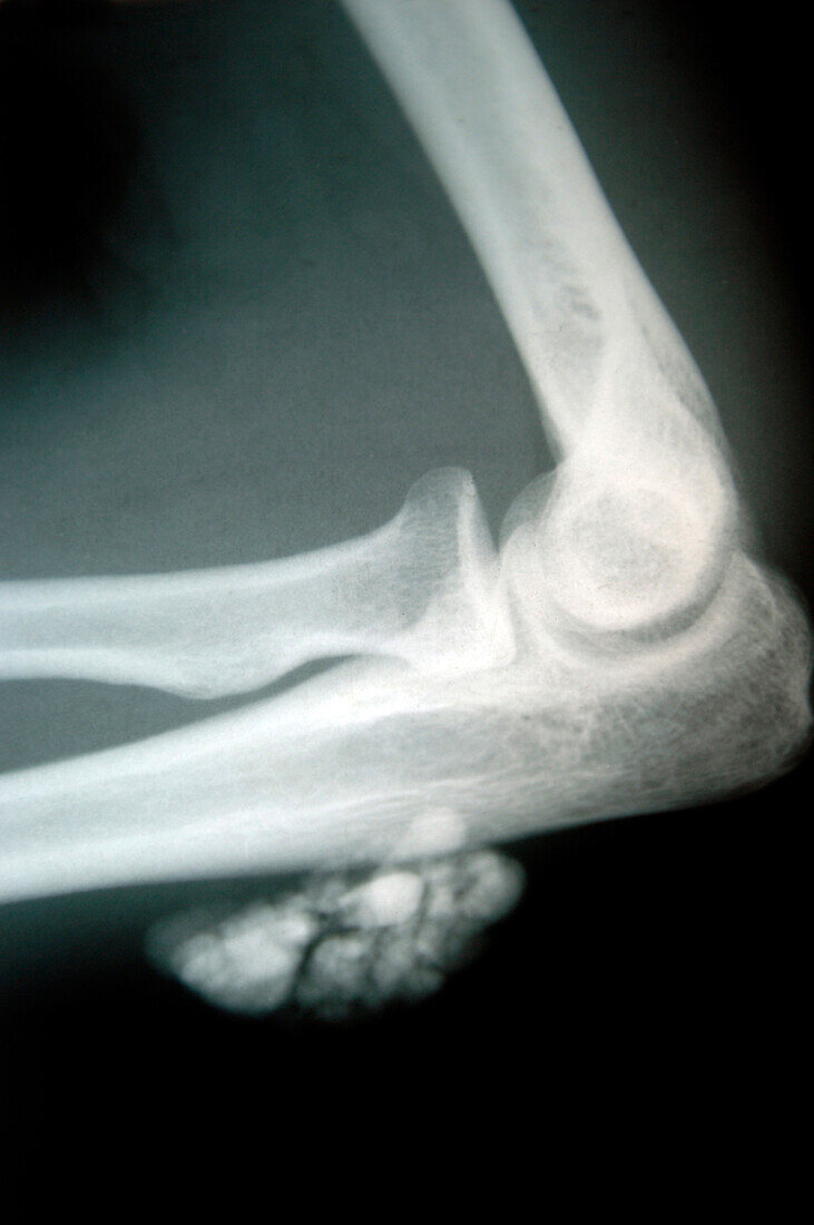 Mycetoma, X-ray