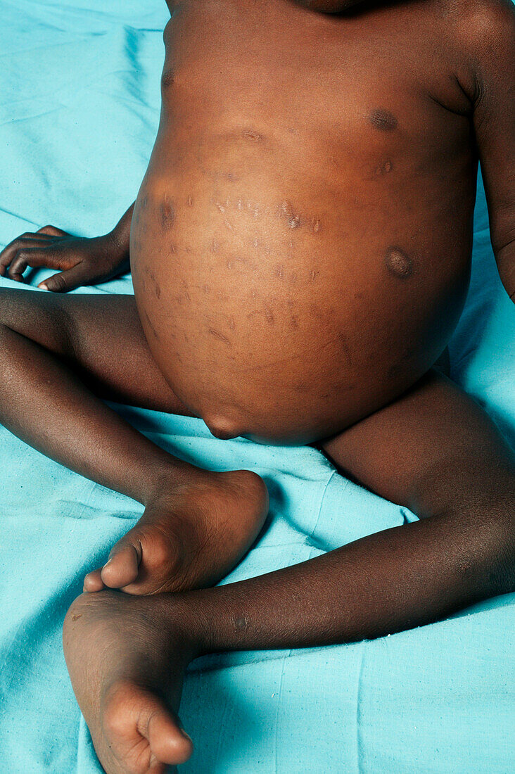 Child with hepatosplenomegaly