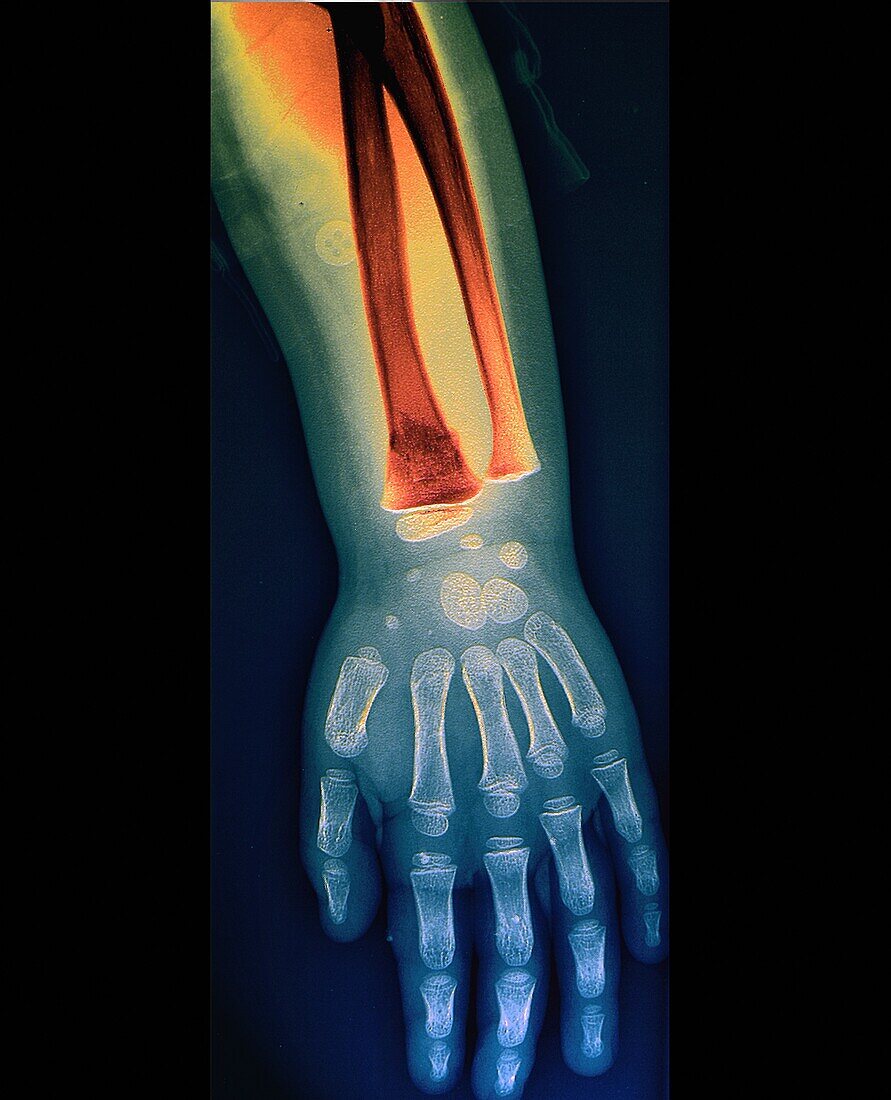 Fractured arm, X-ray