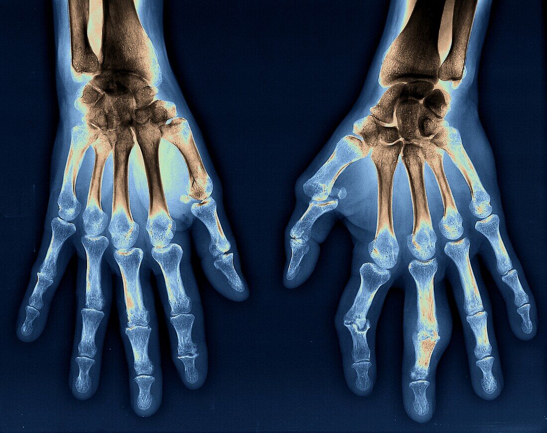 Rheumatoid arthritis, x-ray
