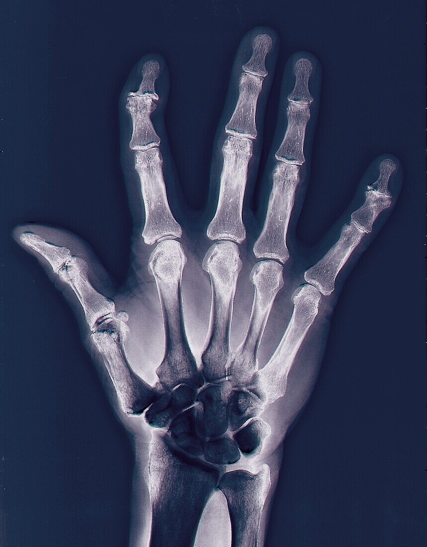 Arthritic hand, X-ray