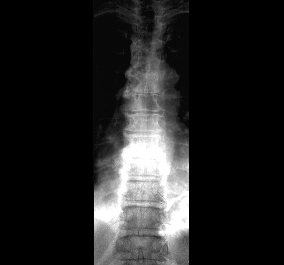 Back pain, X-ray