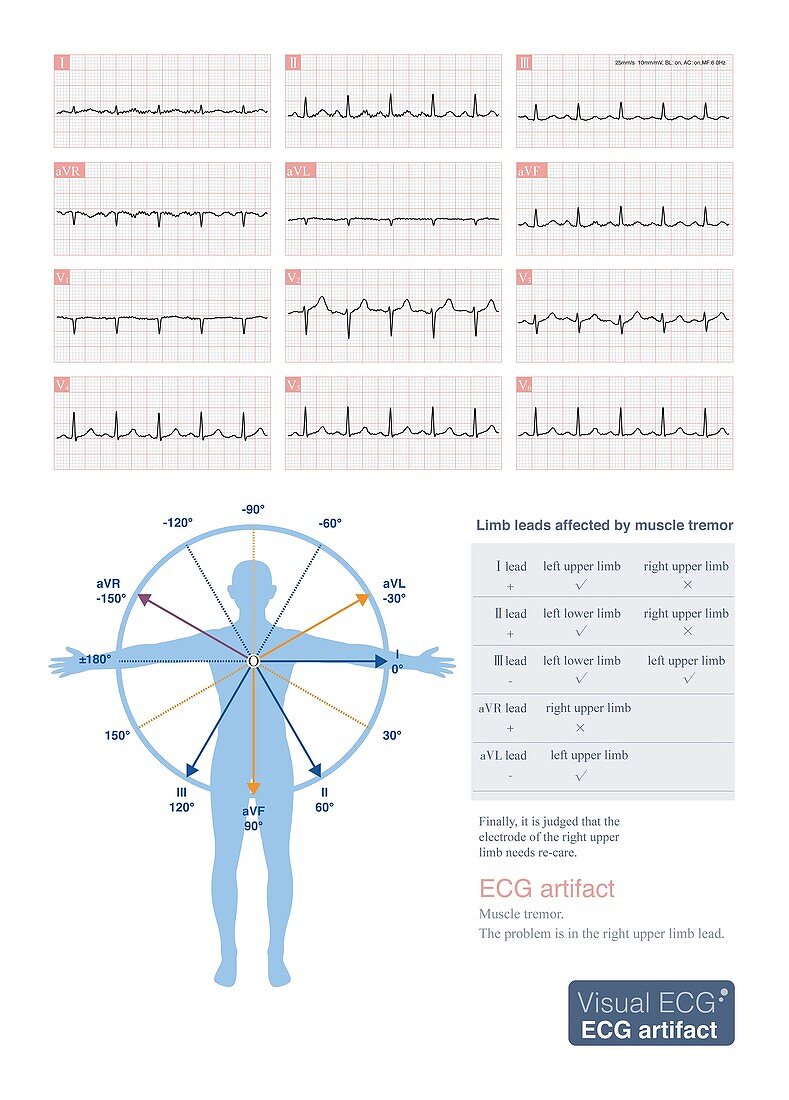 Limb lead muscle tremor on ECG, illustration