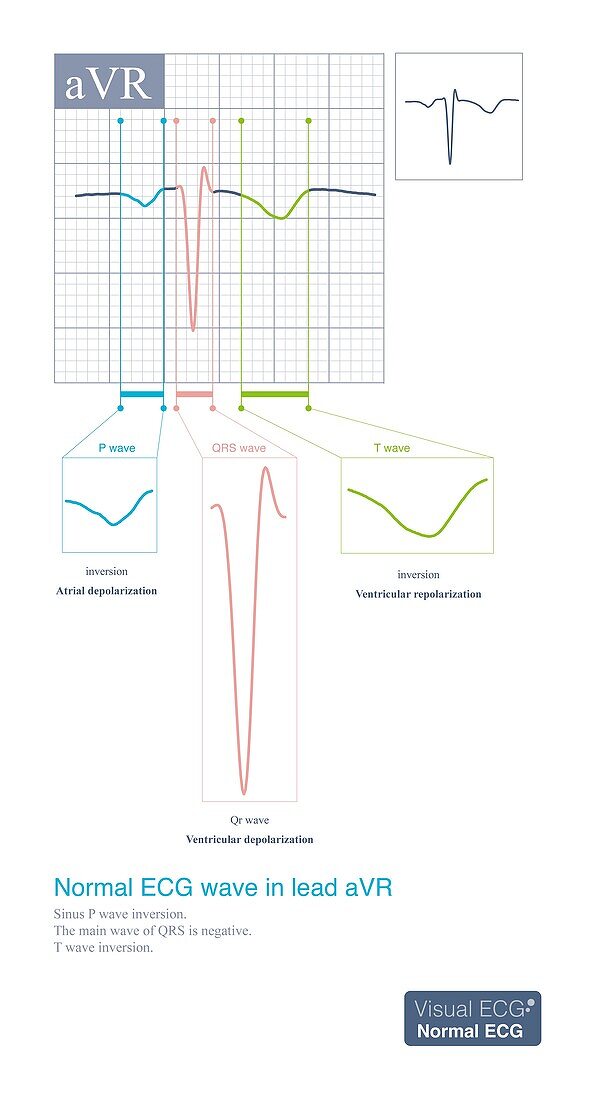 Normal ECG wave in aVR lead, illustration