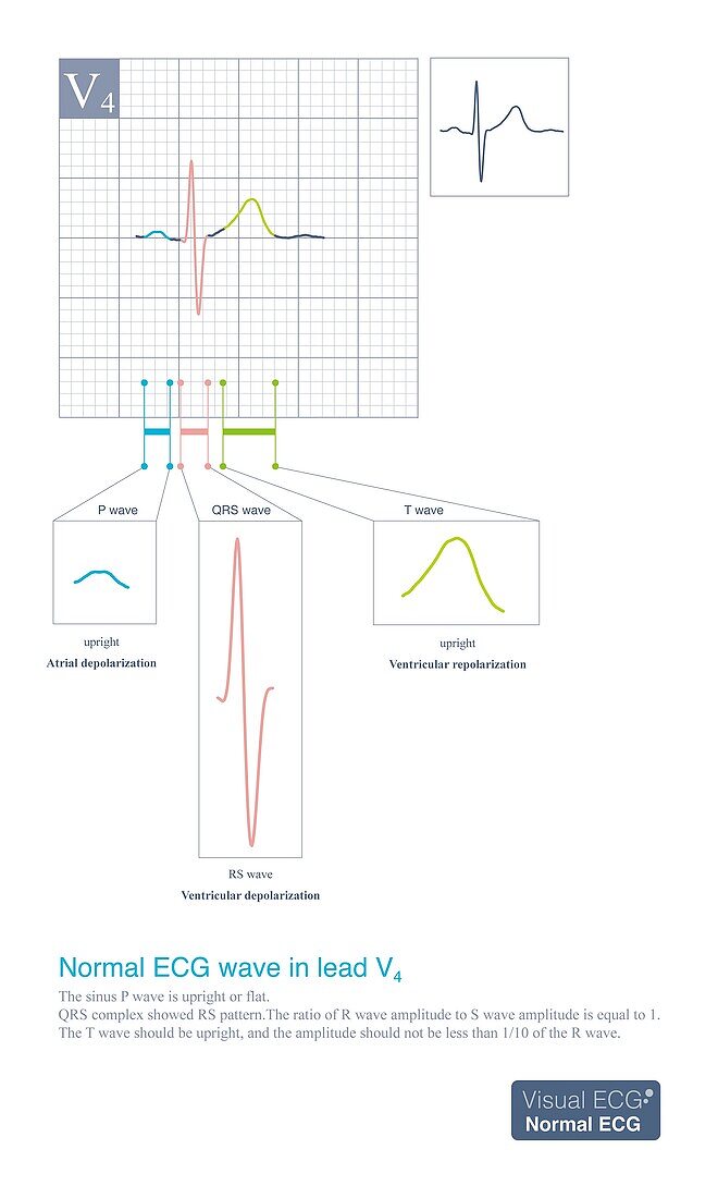 Normal ECG wave in lead V4, illustration