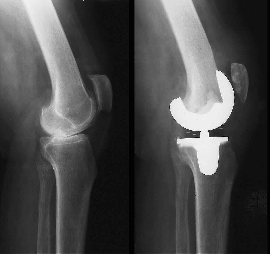 Before and after a total knee replacement, X-ray