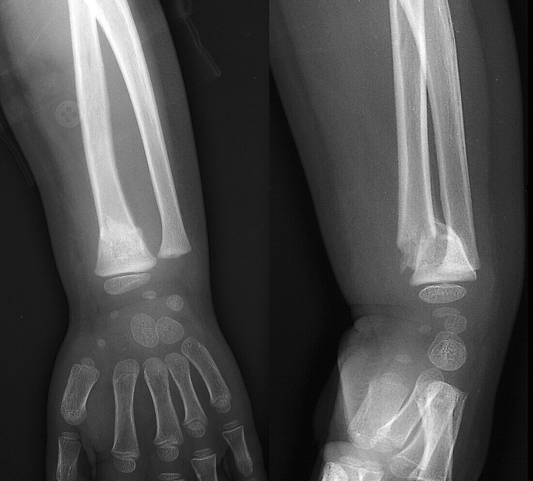 Fractured radius bone, X-ray