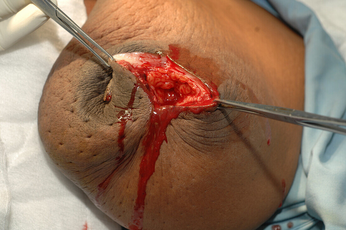 Chronic breast abscess surgery