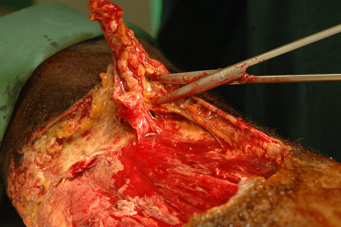 Surgeons removing necrotic skin