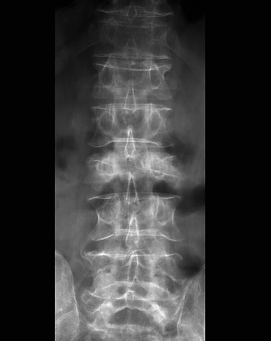 Osteoporosis, X-ray