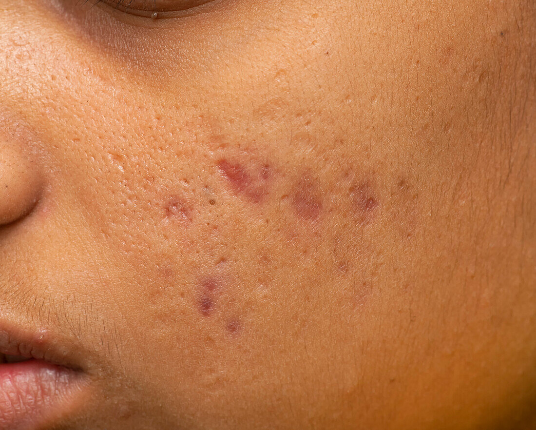 Scarring from acne vulgaris