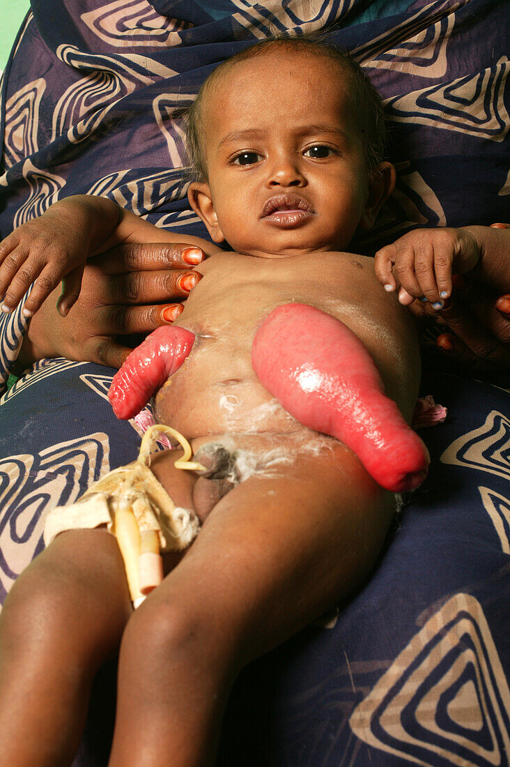 Baby boy with a colostomy