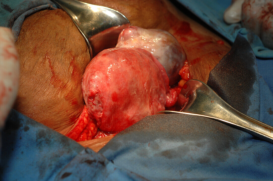 Uterine fibroid surgery