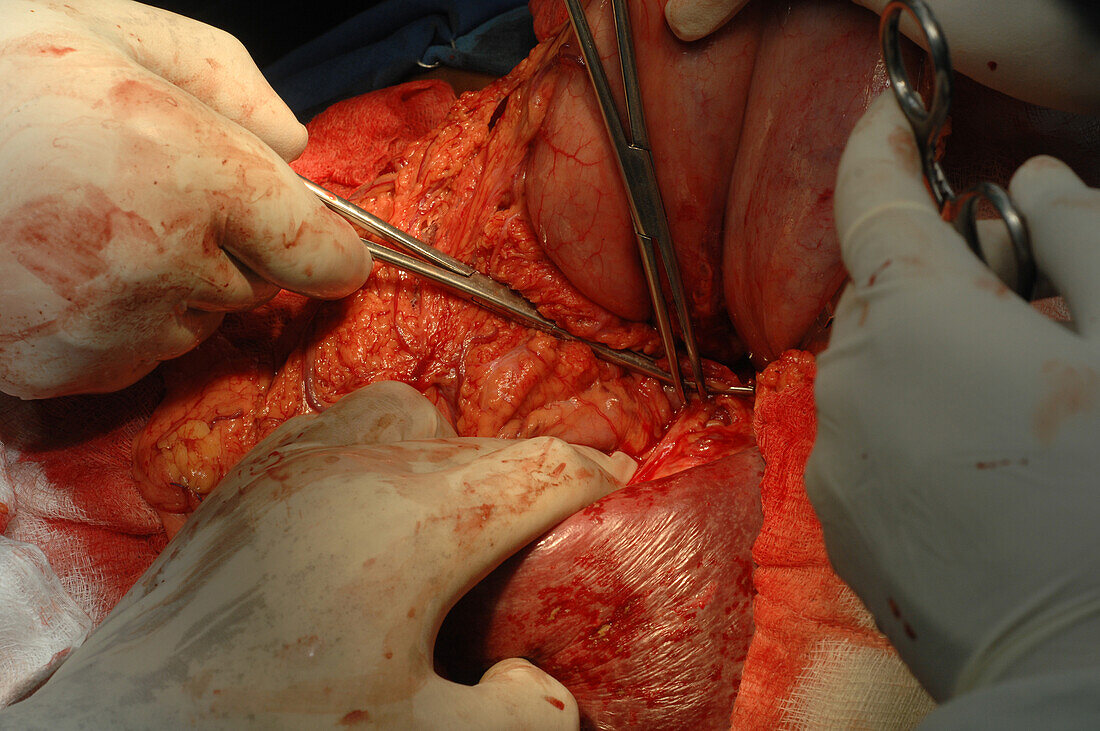 Surgeon removing an enlarged spleen