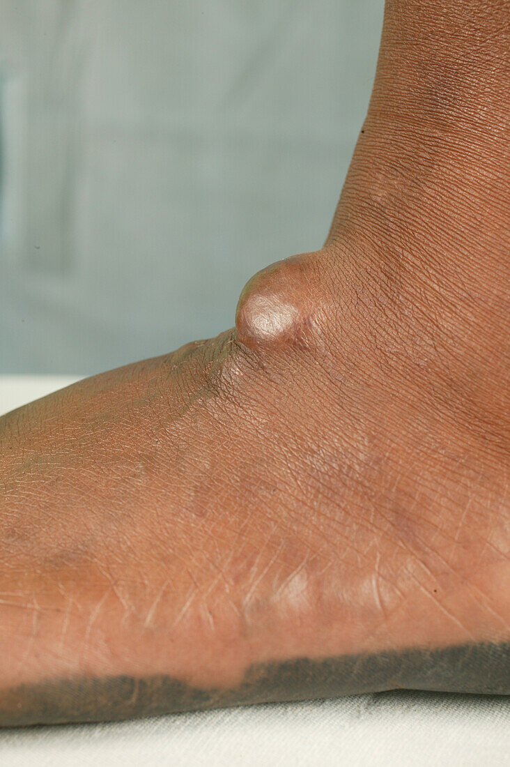 Patient with a sebaceous cyst on their foot