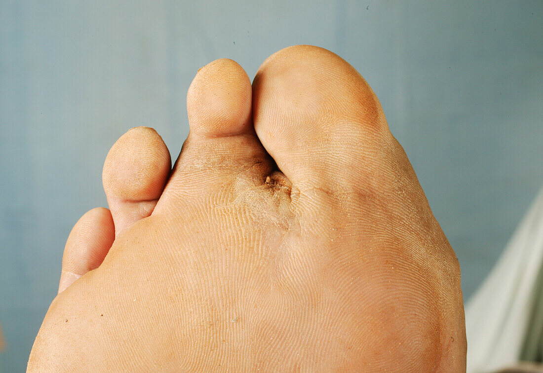 Right foot actinomycetoma