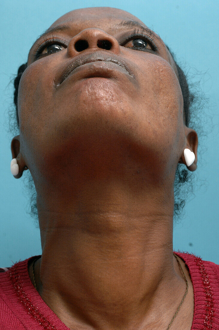 Woman with a small toxic goitre