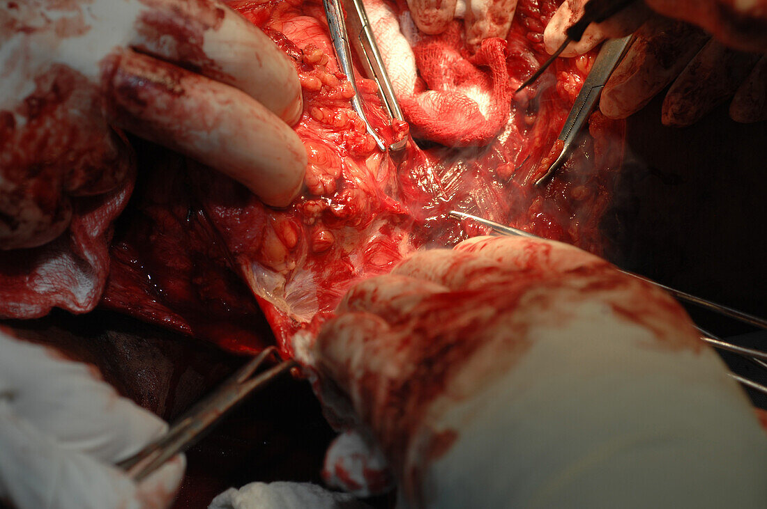 Fibrosarcoma surgery