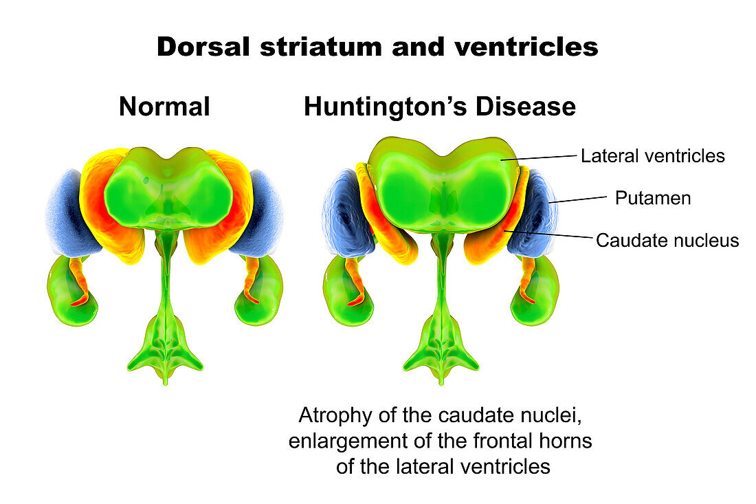 Dorsal striatum and ventricles in Huntington's disease