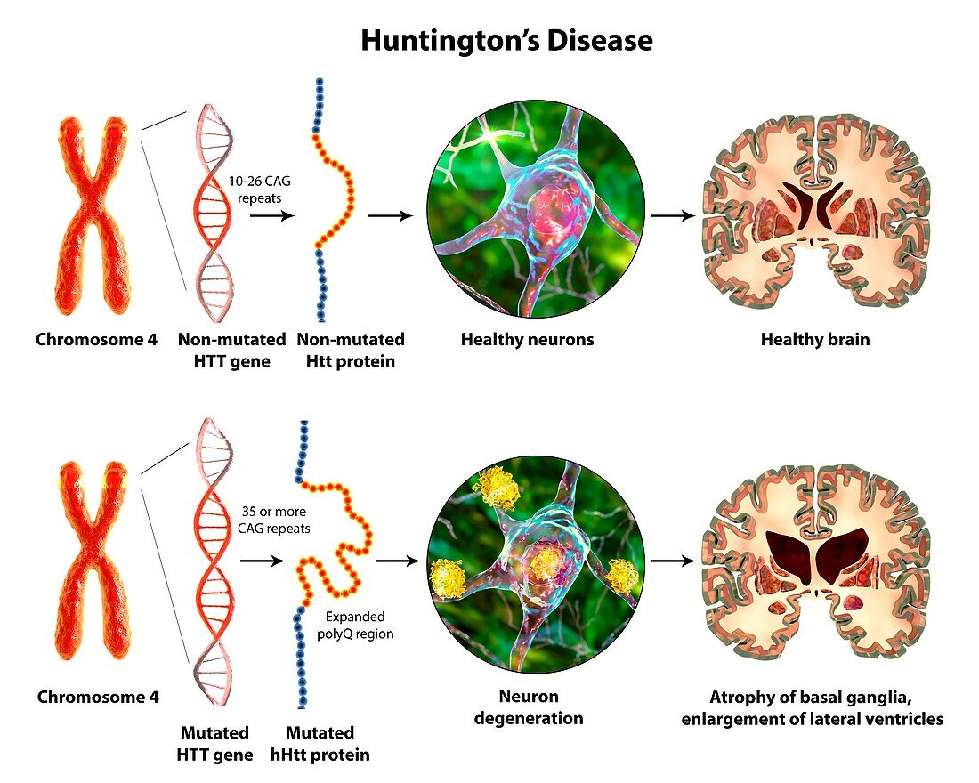 Molecular genesis of Huntington's disease, 3D illustration