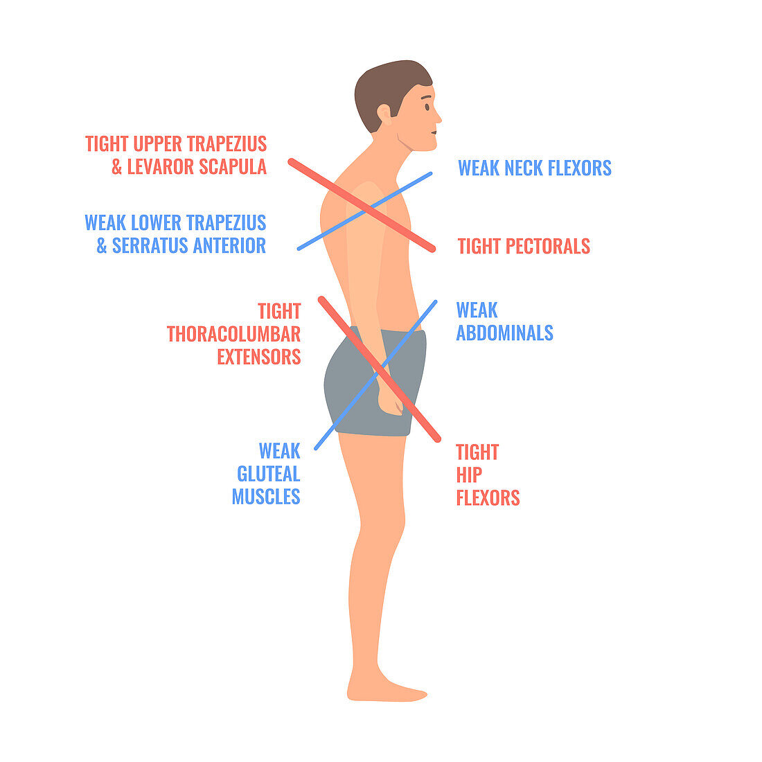 Upper and lower crossed syndromes, conceptual illustration