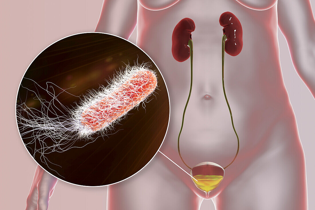Bacterial cystitis, illustration