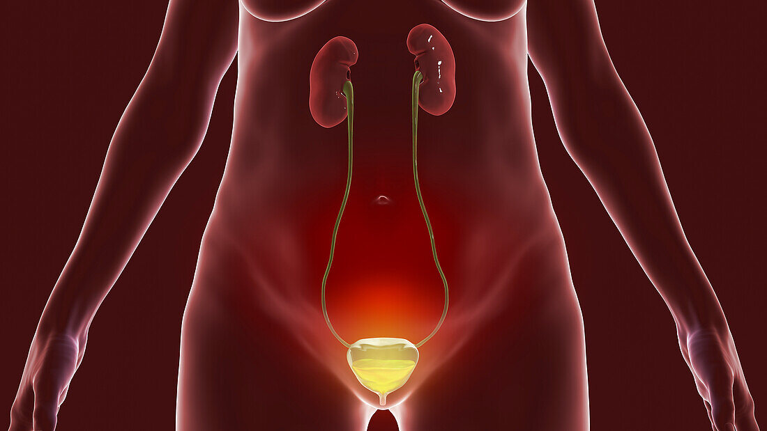 Overactive bladder, illustration