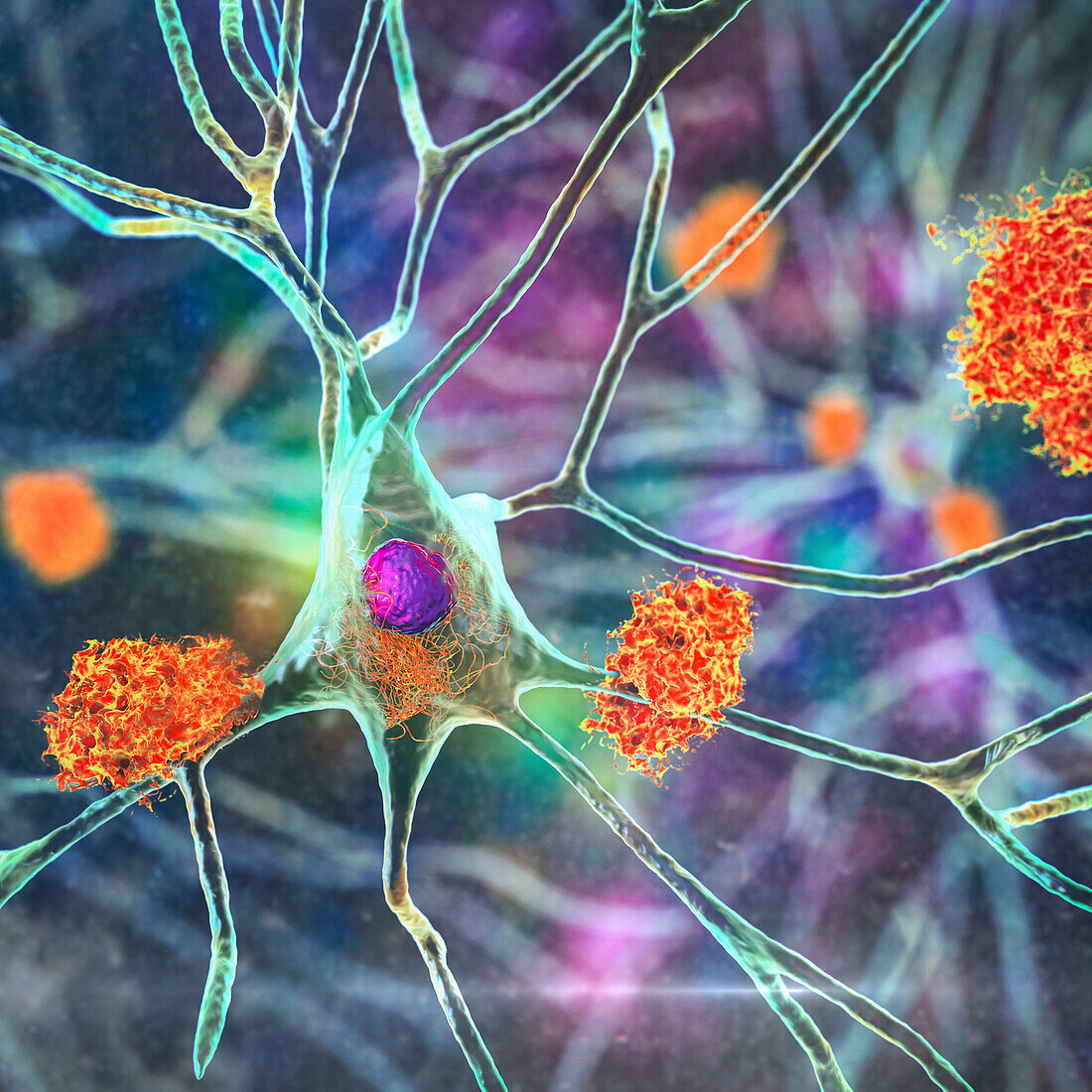 Nerve cells affected by Alzheimer's disease, illustration