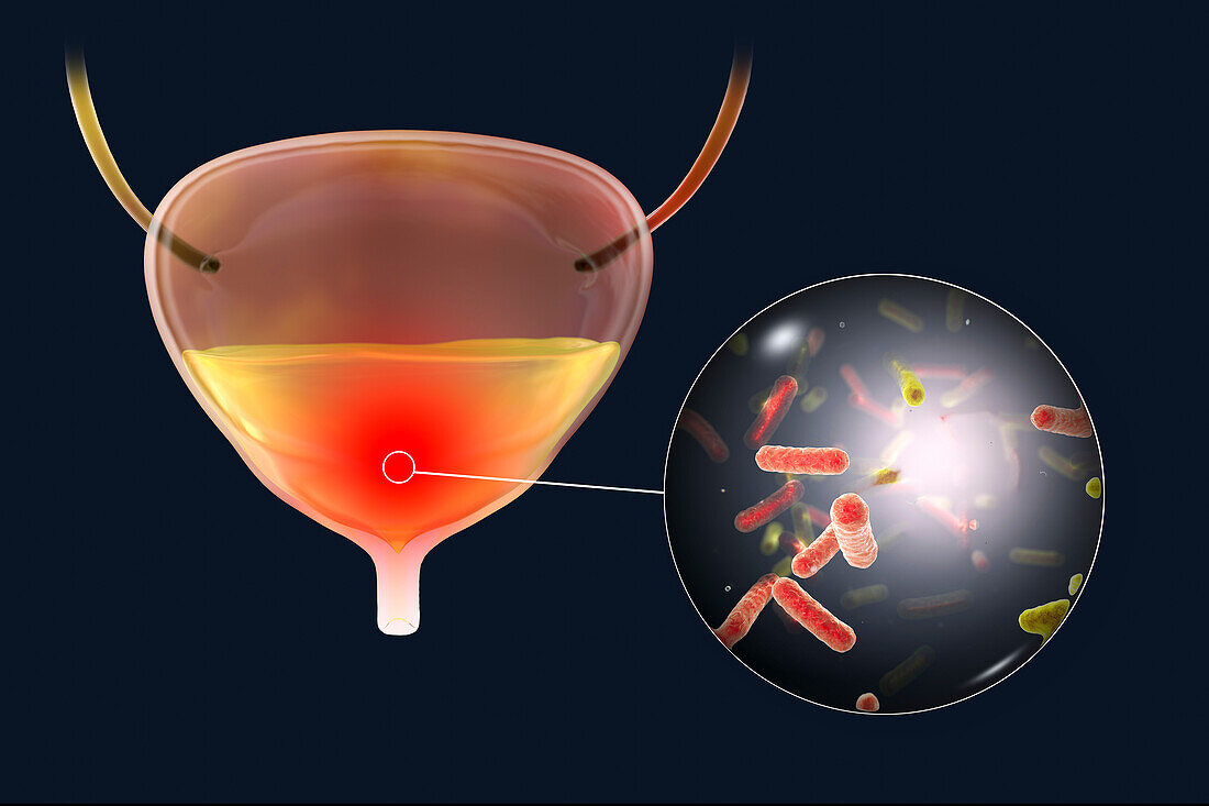 Bacterial cystitis, illustration