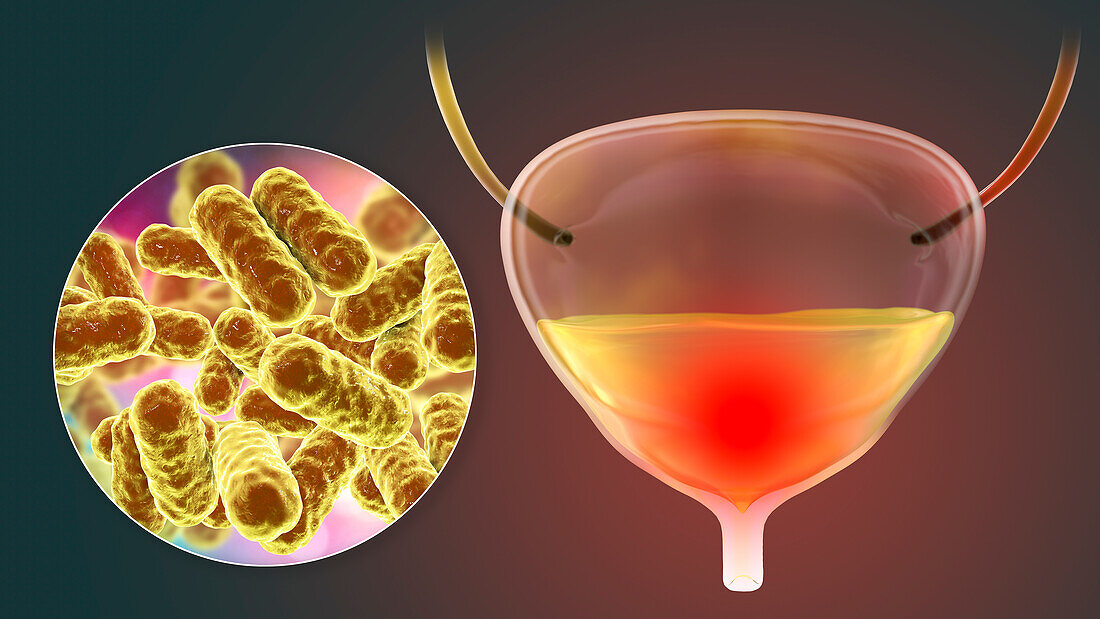 Bacterial cystitis, illustration