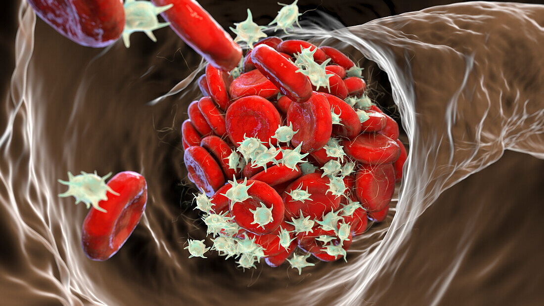 Blood clot, illustration