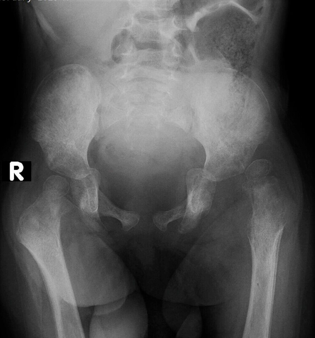 Developmental dysplasia of the hip, X-ray