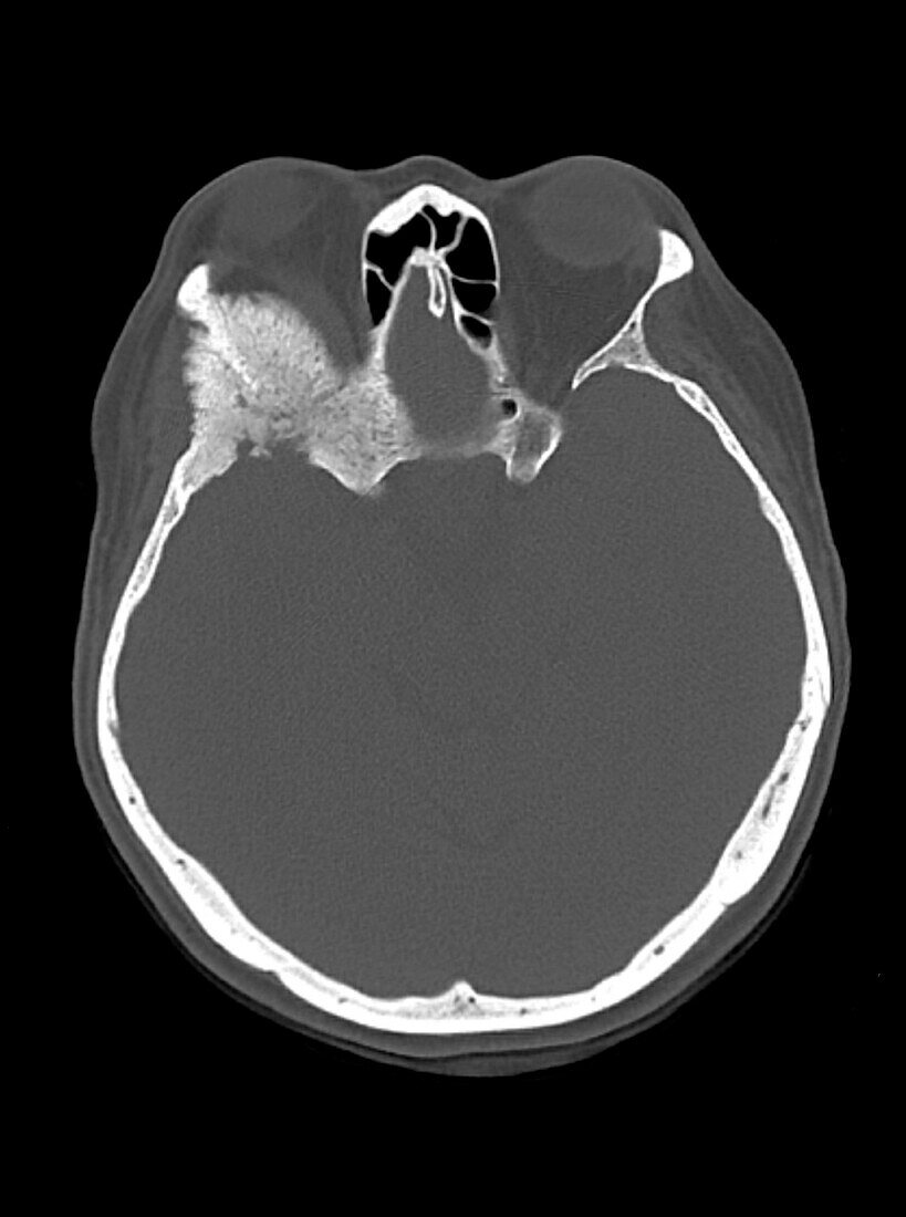 Intraosseous meningioma, CT scan