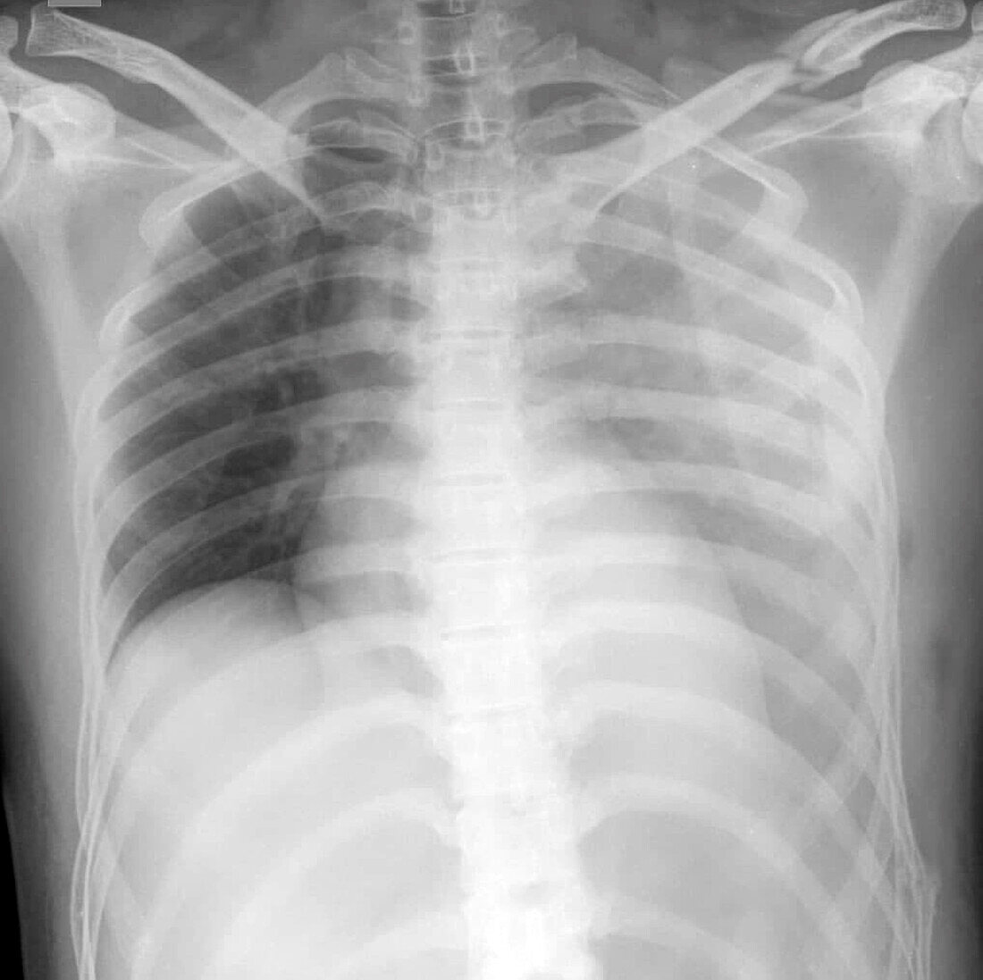 Haemothorax and multiple fractures , X-ray