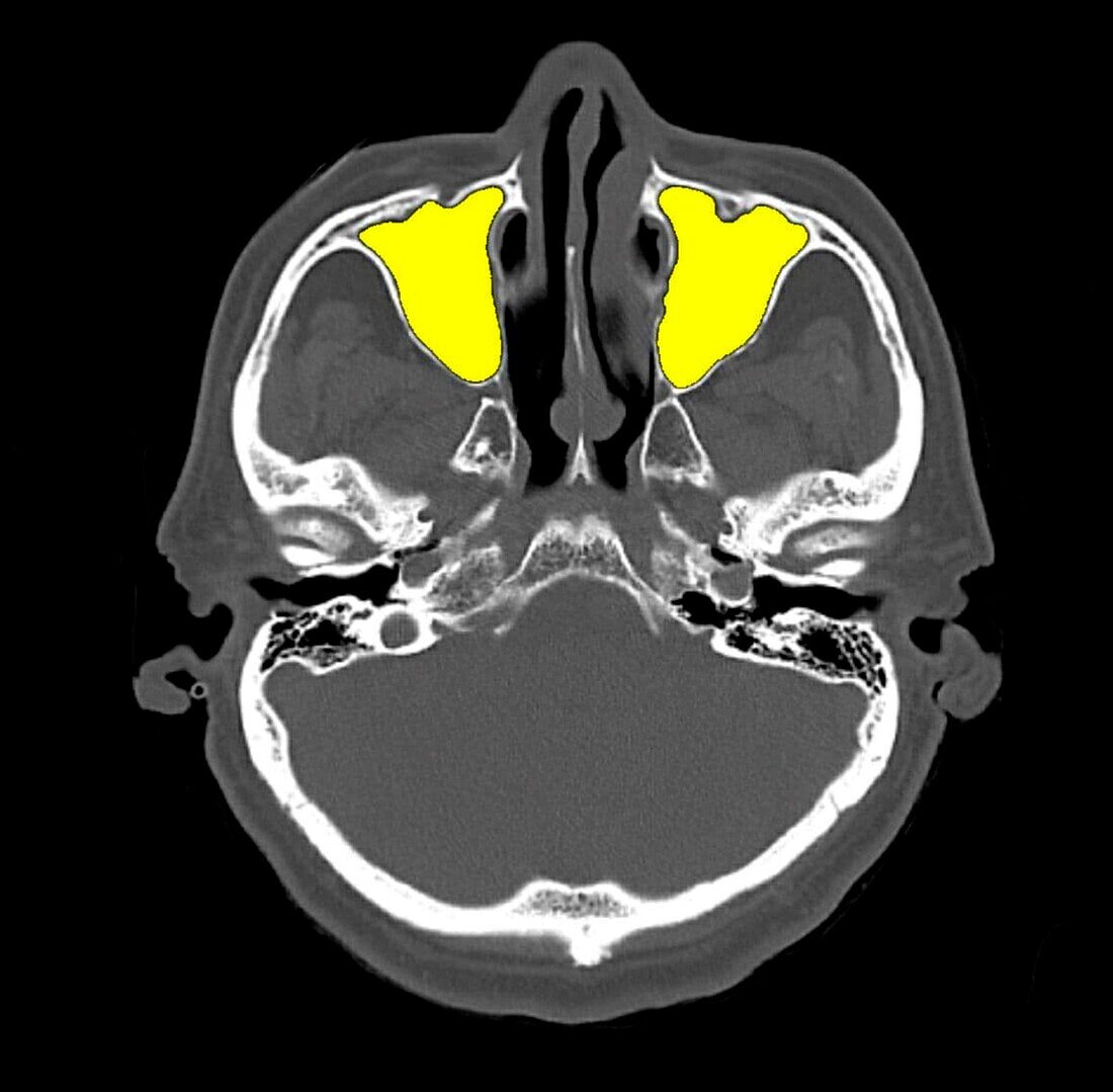 Paranasal sinus anatomy, CT scan