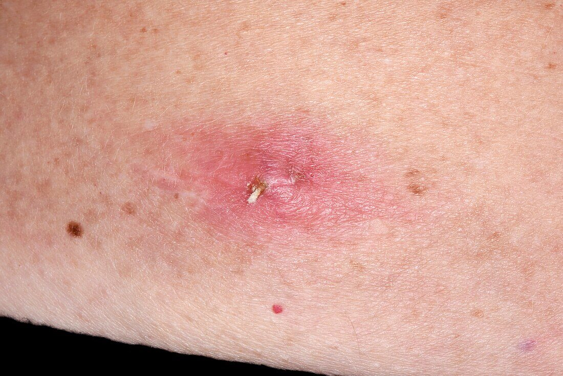 Infected insect bite on leg