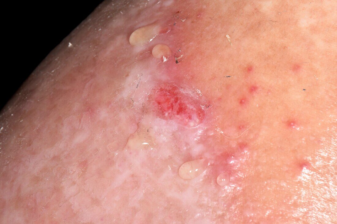 Oedematous legs with varicose eczema