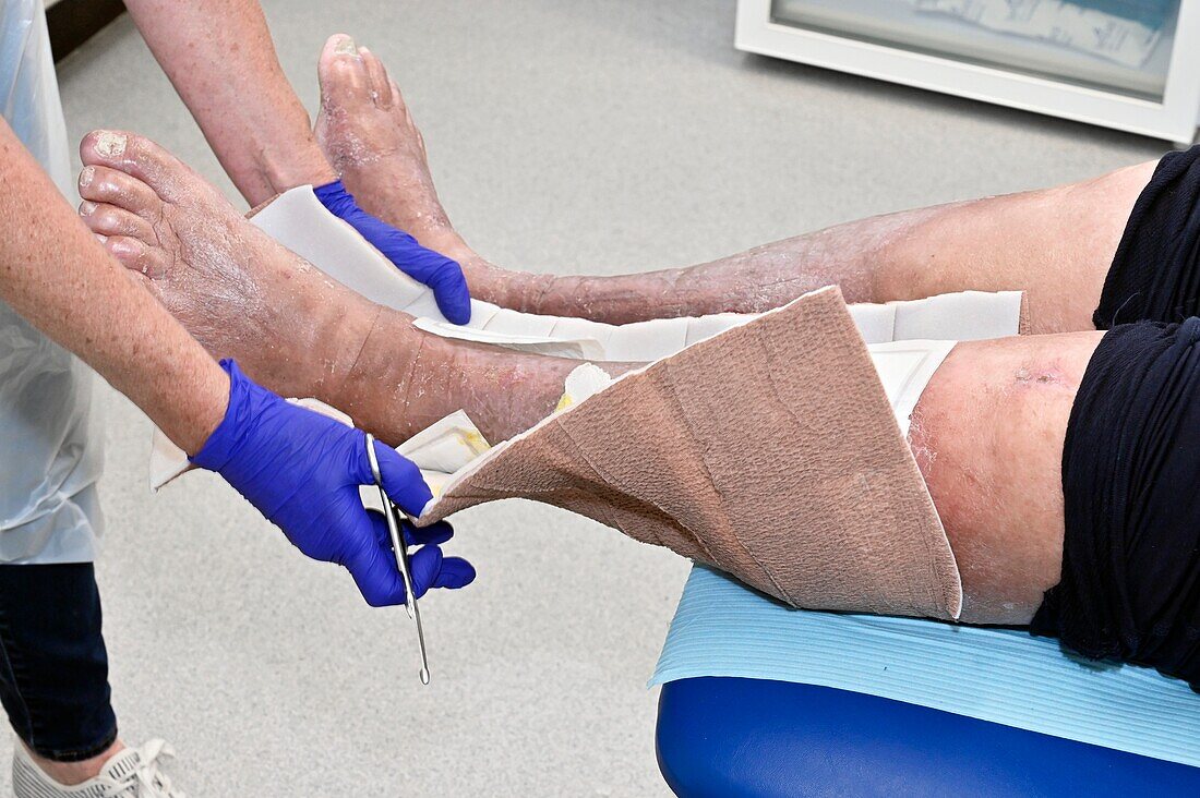 Compression bandaging being removed