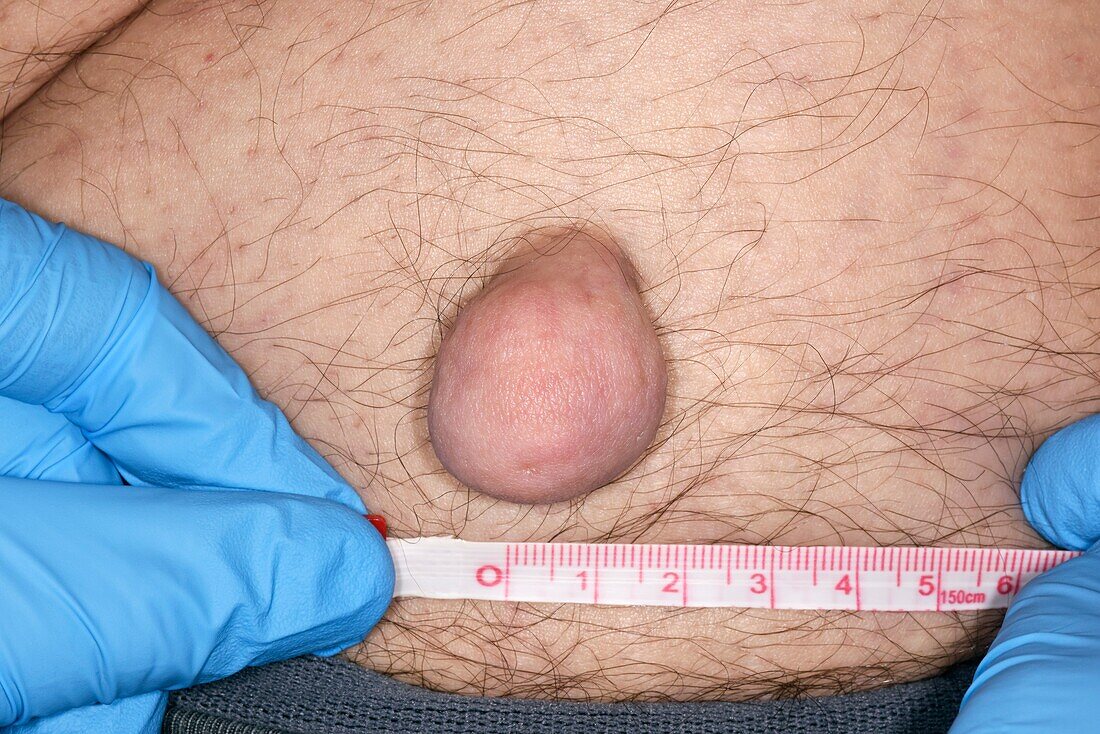 Fibroepithelial polyp being measured
