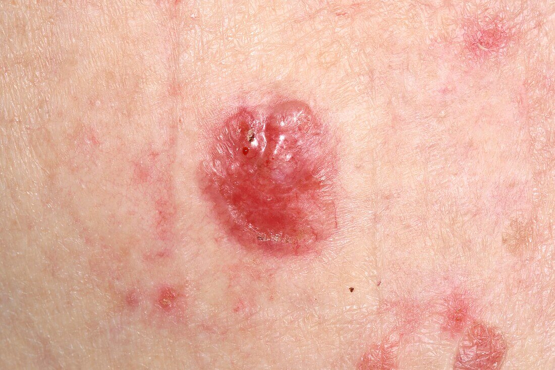 Nodular basal cell carcinoma