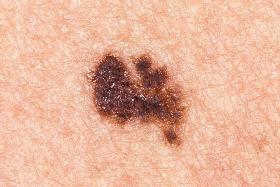 Malignant melanoma