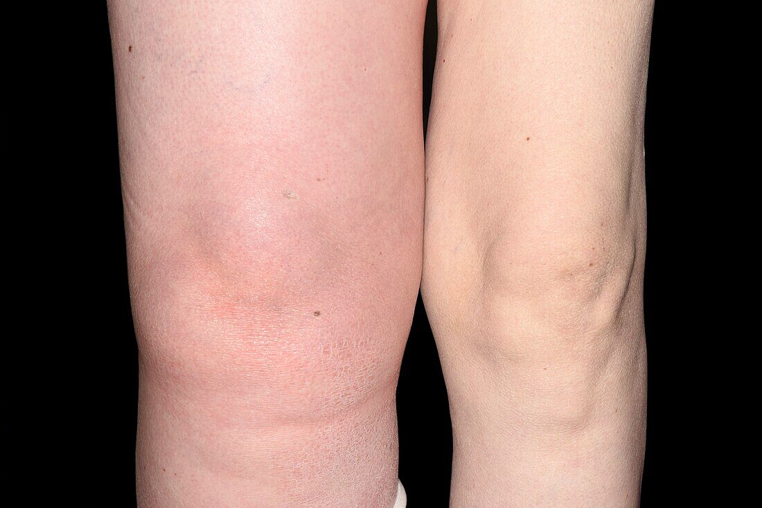 Swelling of leg due to pelvic mass