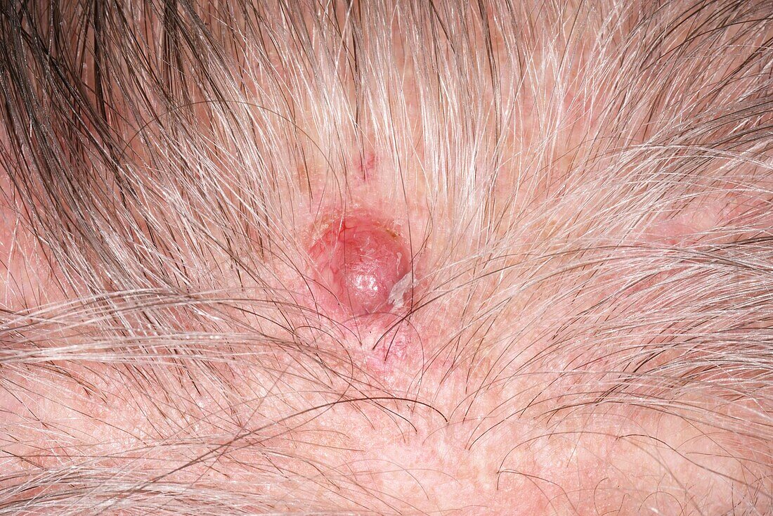 Nodular basal cell carcinoma