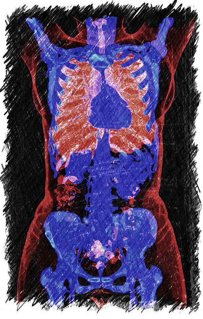 Rib cage and pelvis, 3D CT scan