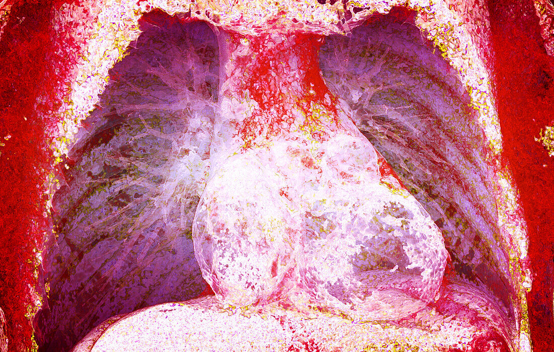 Healthy lungs and heart, 3D CT scan