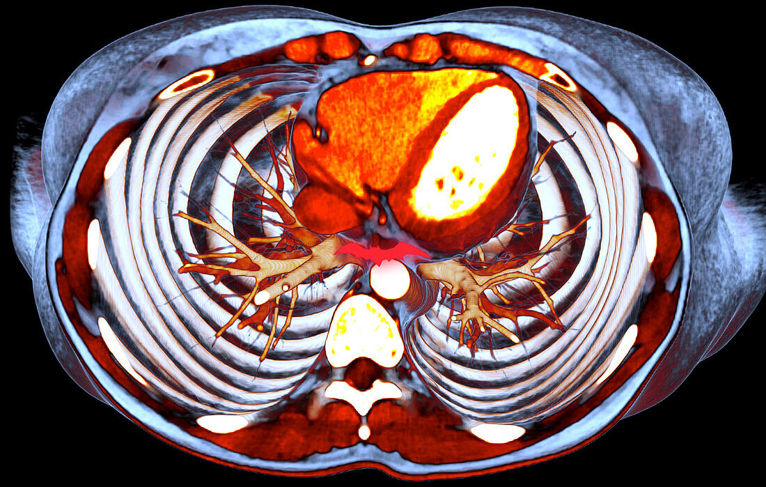 Healthy heart and lungs, 3D CT scan